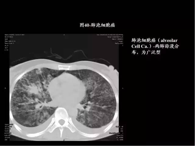 為什么做胸、腹部CT掃描時(shí)需要吸氣-屏氣-吐氣？