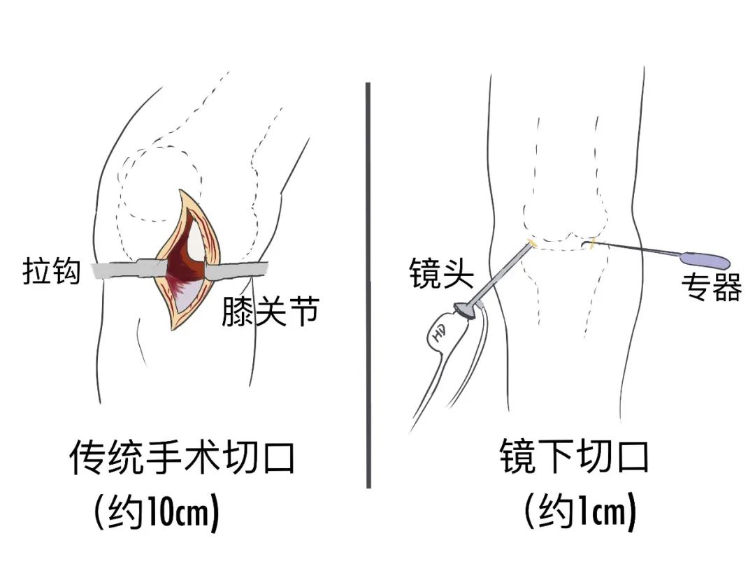 帶你一起認識關(guān)節(jié)鏡